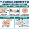 包皮翻開後水腫怎麼快速消退的 5 大緊急處置步驟醫學圖解