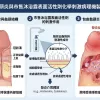 包皮龜頭炎與市售沐浴露表面活性劑化學刺激病理機製示意圖