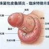 念珠菌包皮龜頭炎與私處真菌感染的臨床特徵：龜頭蛻皮、白斑與包皮紅腫視覺示意圖